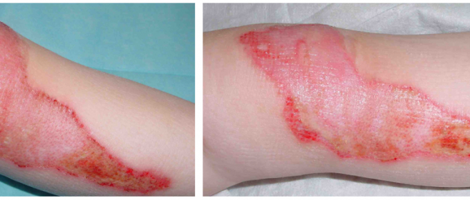 6 Steps You Need to Do After Suffering a Gruesome Burn Injury