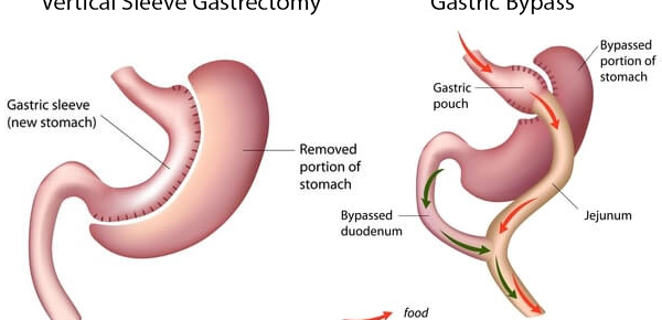 The Finance Options Available for Gastric Sleeve Surgery