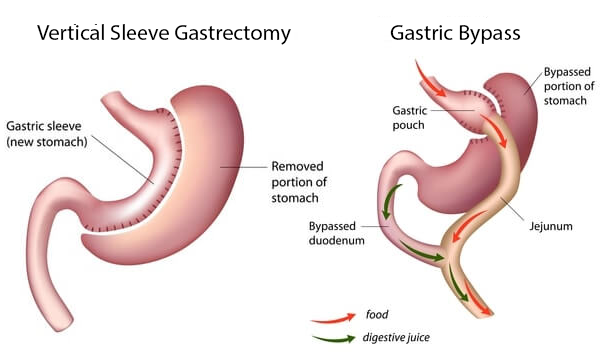 image - Overview of Gastric Sleeve Surgery Cost